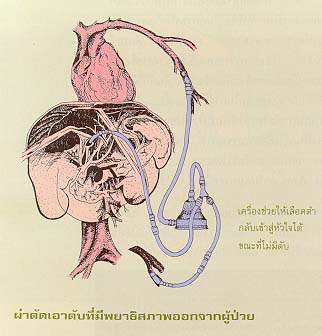 การผ่าตัดเปลี่ยนตับ