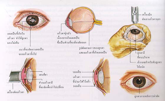 การผ่าตัดปลูกอวัยวะ