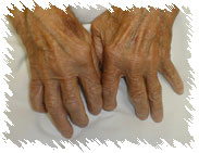 โรครูมาตอยด์ (Rheumatoid)