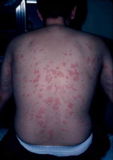 ลมพิษ Urticaria