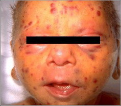 โรคหัดเยอรมัน (Rubella)