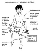 โรคโปลิโอ (Poliomyelitis)