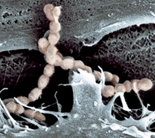 โรคติดเชื้อสเตรปโตคอกคัส ซูอิส (Streptococcus suis )