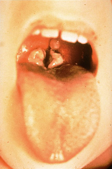 โรคคอตีบ (Diphtheria)