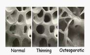 โรคกระดูกพรุน (Osteoporosis)