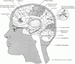 โรคอัลไซเมอร์ (Alzheimer)
