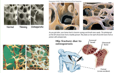 โรคกระดูกพรุน (Osteoporosis)