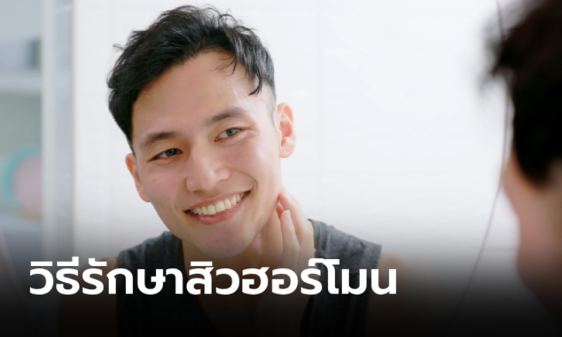 5 วิธีรักษาสิวฮอร์โมนในผู้ชาย ทำง่ายเพื่อผิวหน้าใสในแบบธรรมชาติ